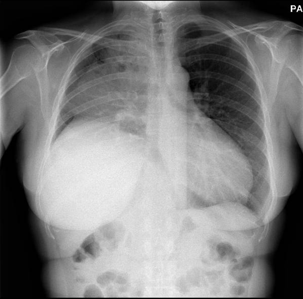 Lingoma de célula B grande pulmonar